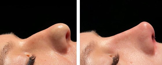 Ринопластика: до и после – фото 5